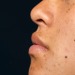 Why Summer is Prime Time for Melasma Flare-Ups